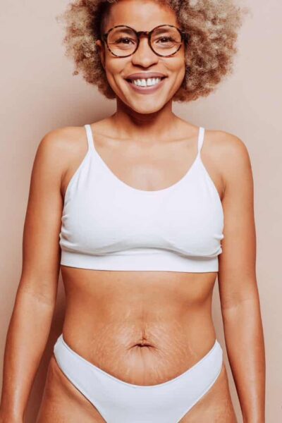 how to get rid of stretch marks