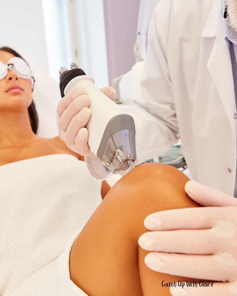laser to get rid of stretch marks